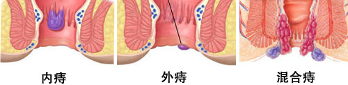 痔疮的好的治疗方法